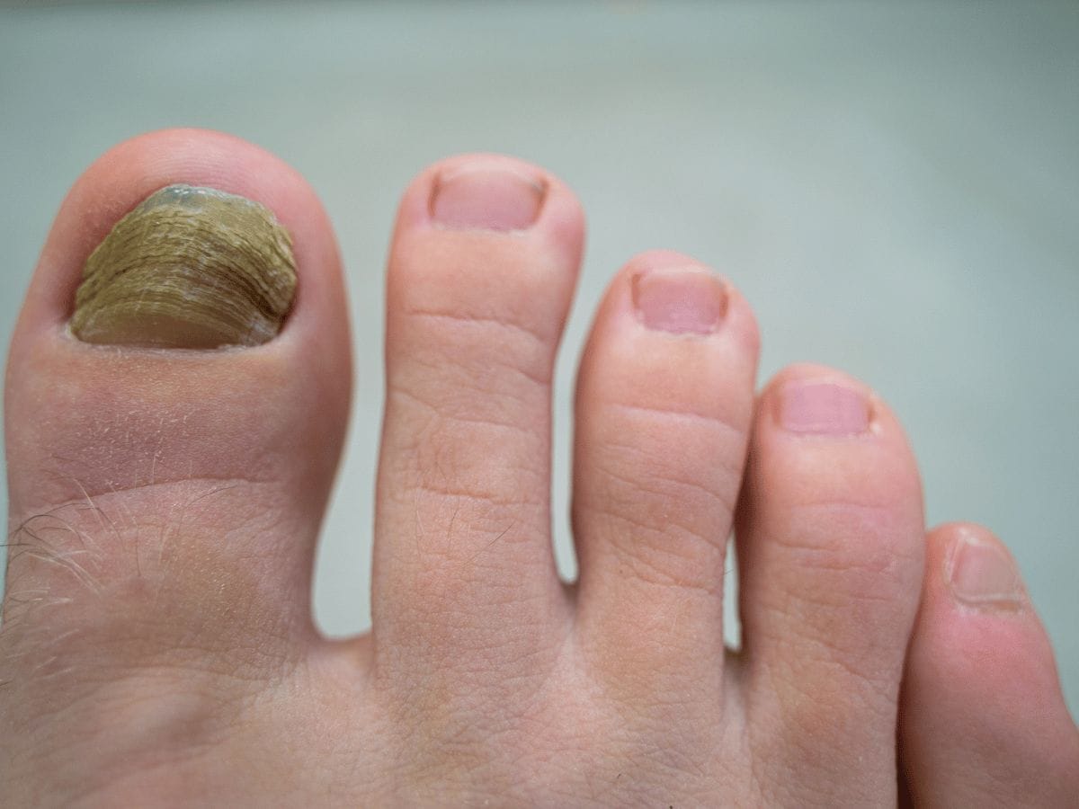 nail fungus on a patient's foot