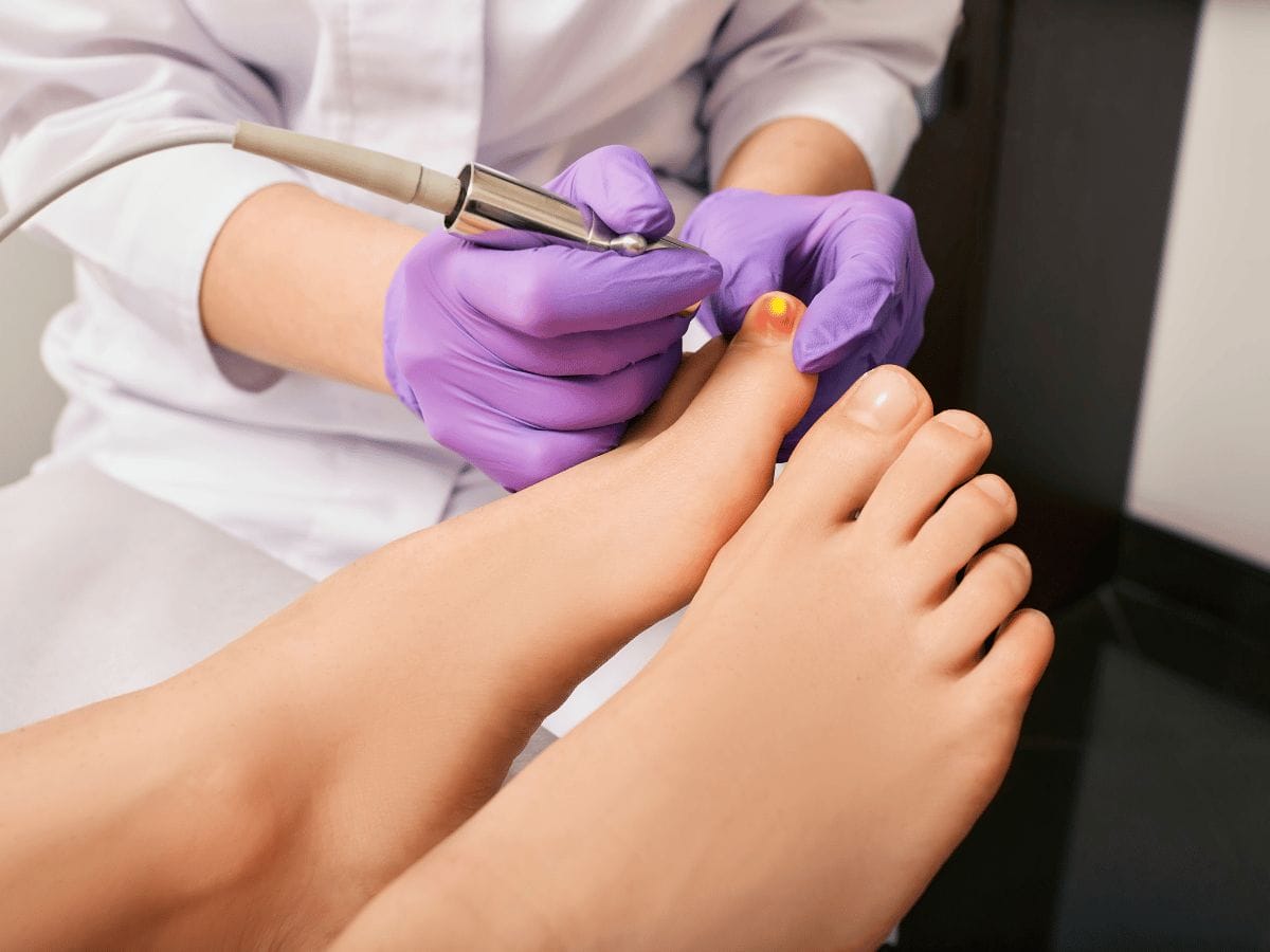 a doctor giving laser nail treatment on a foot of a patient