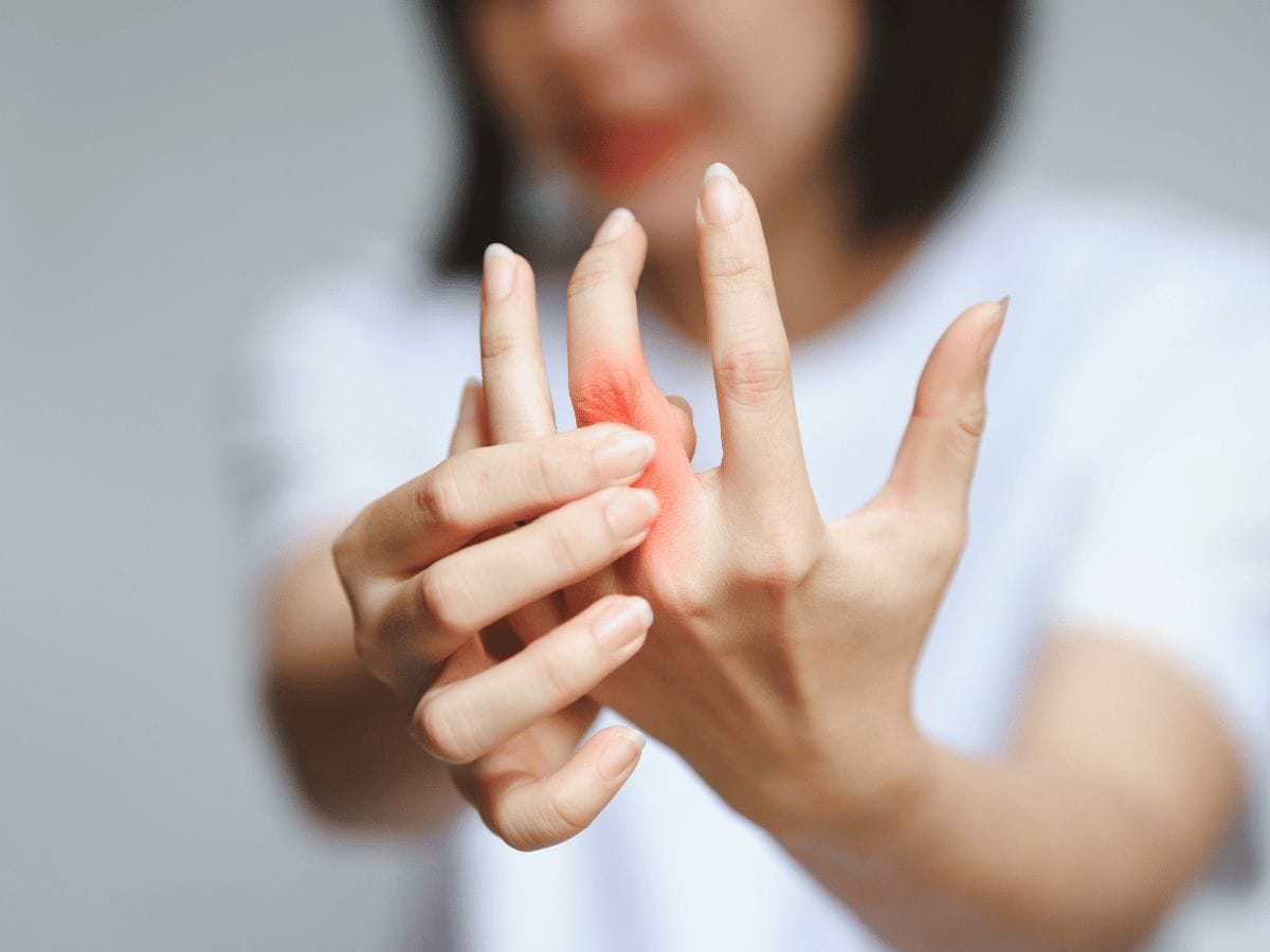 A patient showing their hand effected by Rheumatoid Arthritis