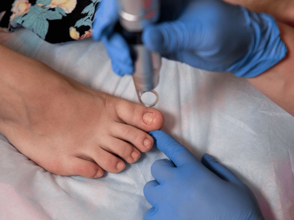 doctor treating foot fungus of a patient using medical tool