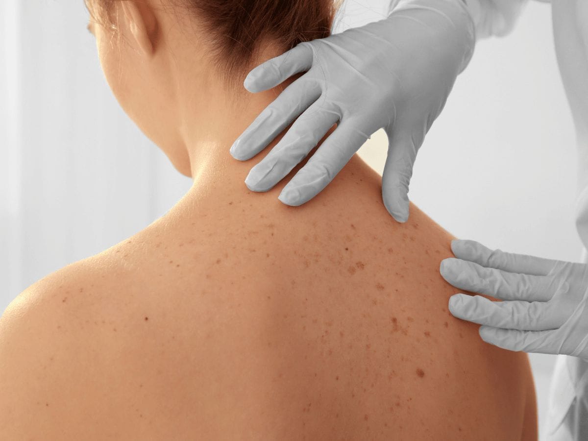 doctor examining melanoma patient's back and neck