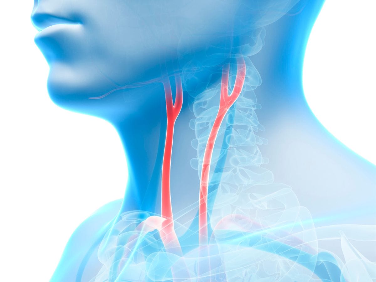 3d image of a carotid artery