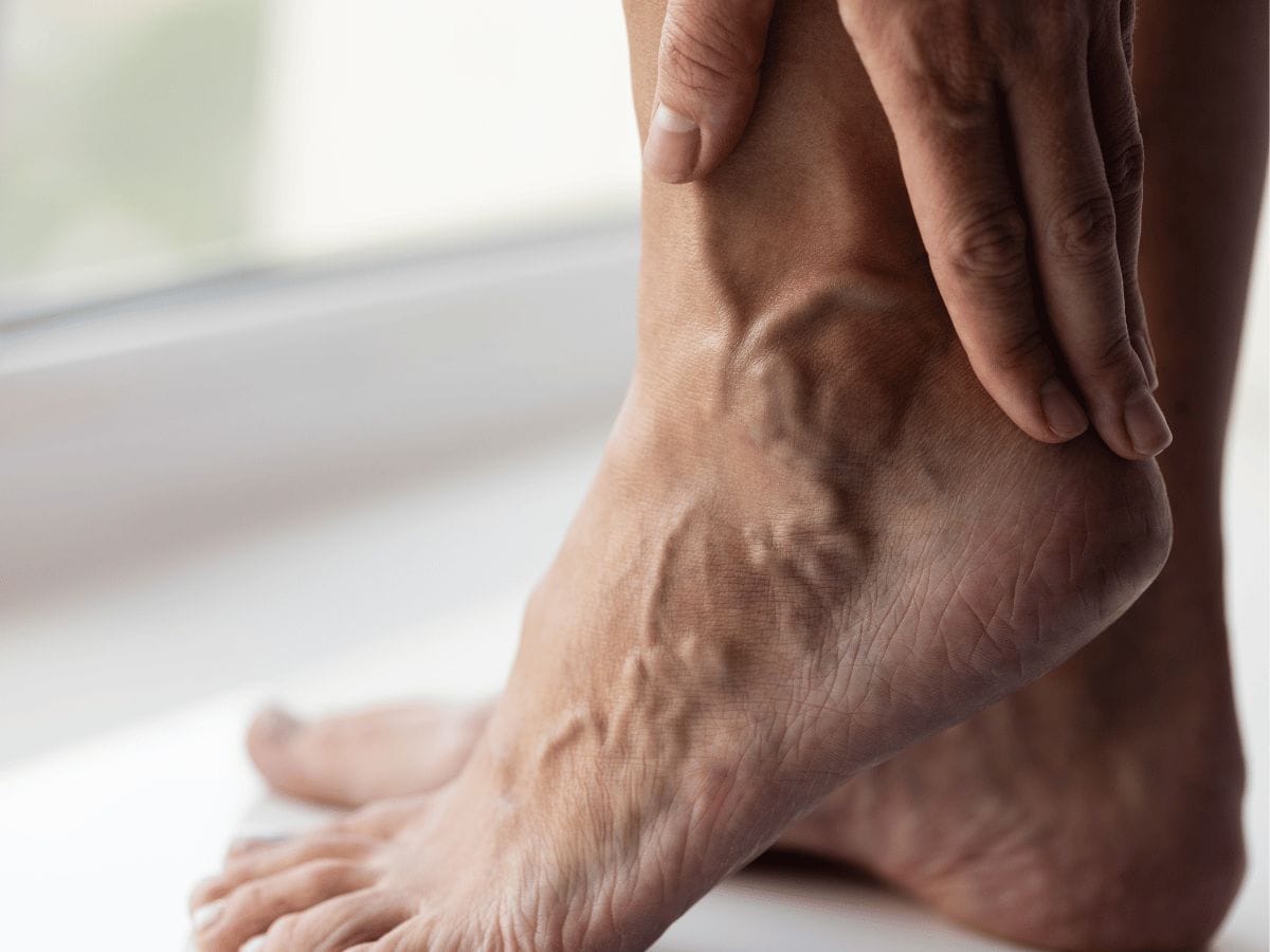 A patient who has a vein disease showing their leg veins