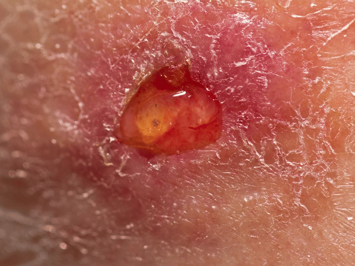 Venous Leg Ulcer of a patient