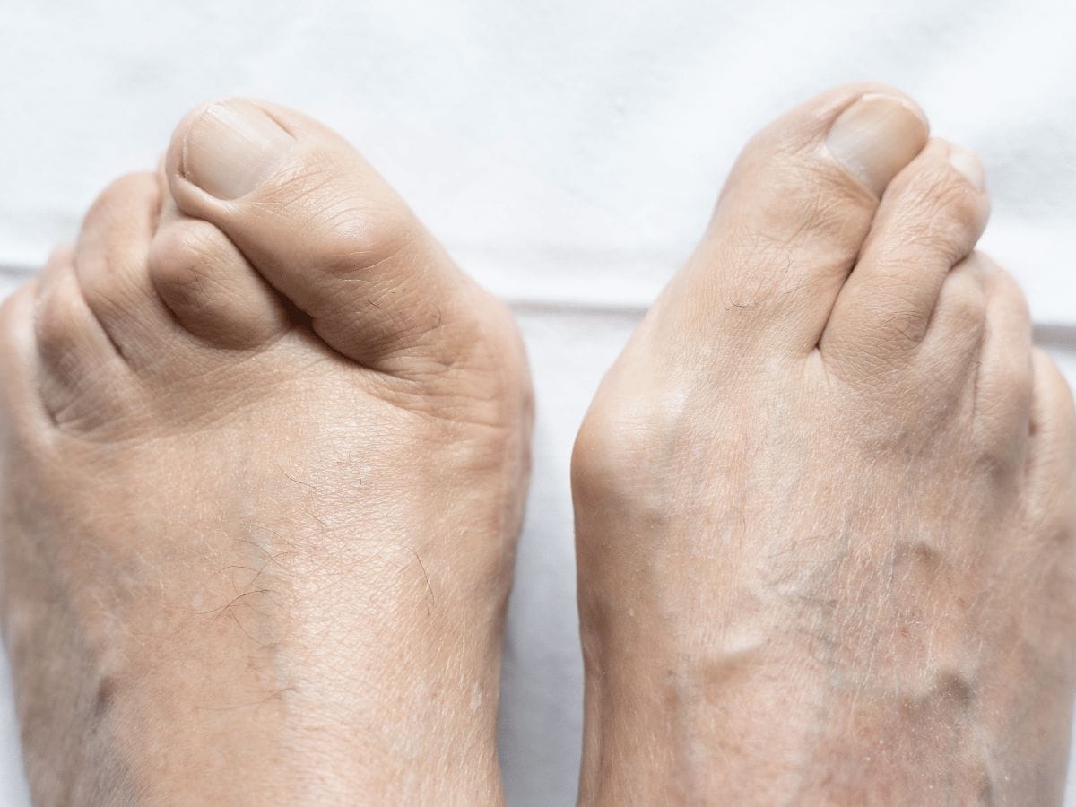 patient's leg who has hammertoe