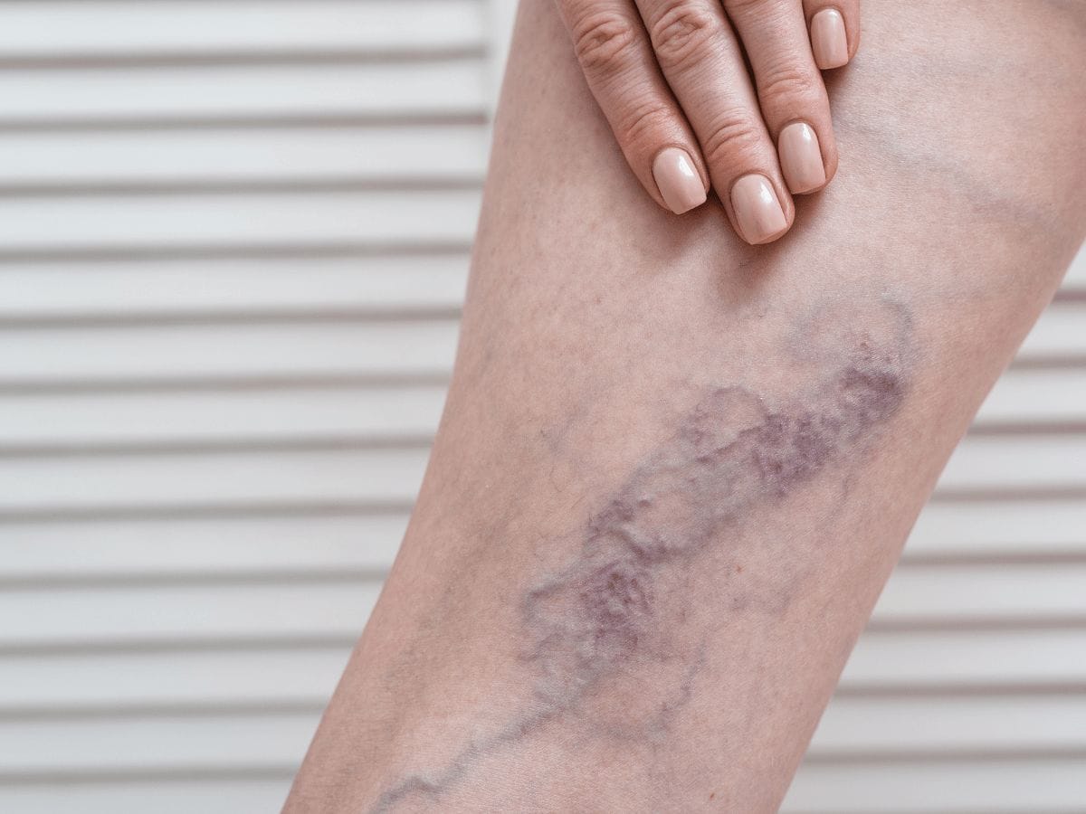 a patient showcasing their leg that has deep vein thrombosis