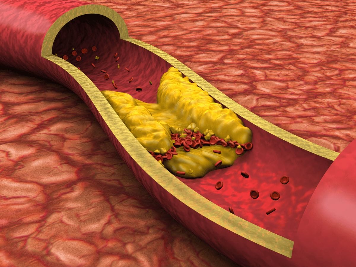 a 3d image of fat deposits in the arteries