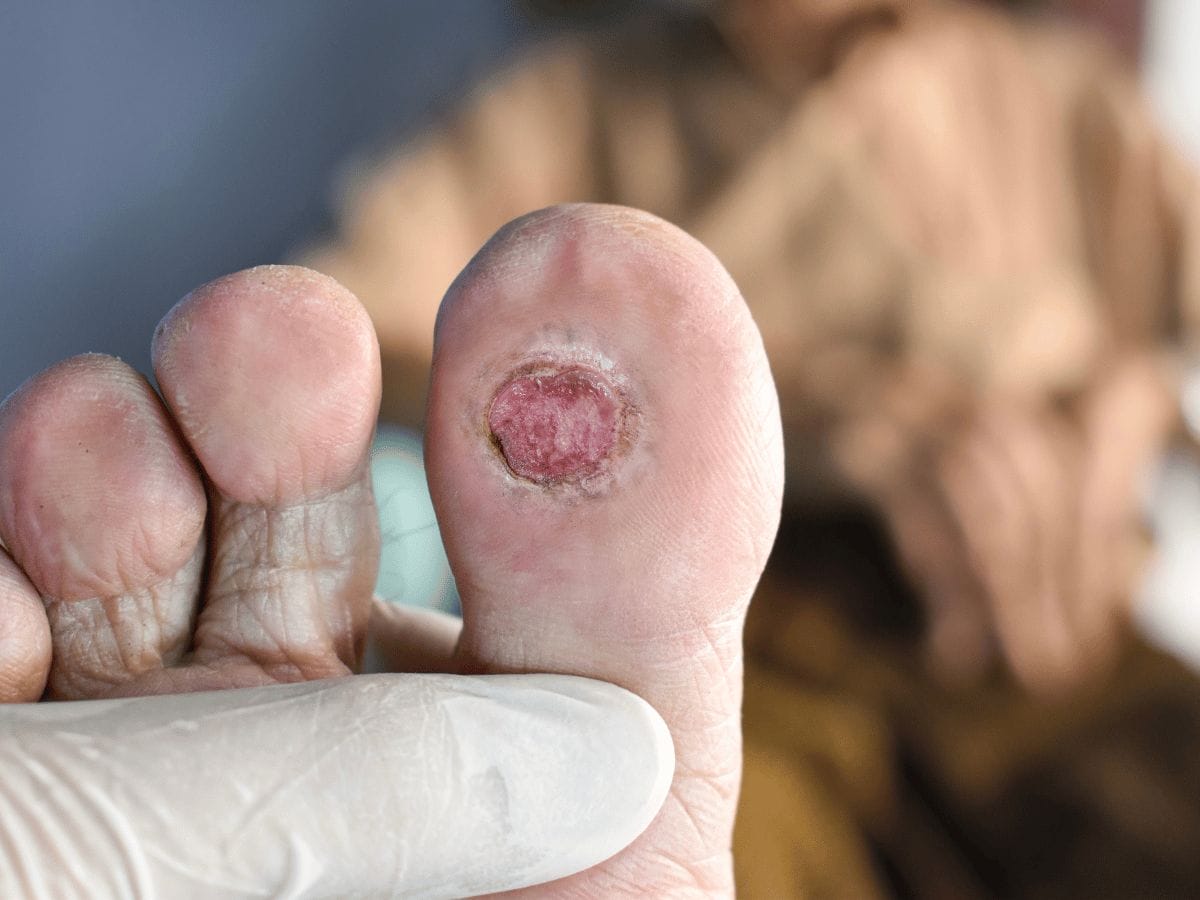 a patient's foot thumb with diabetic foot ulcer