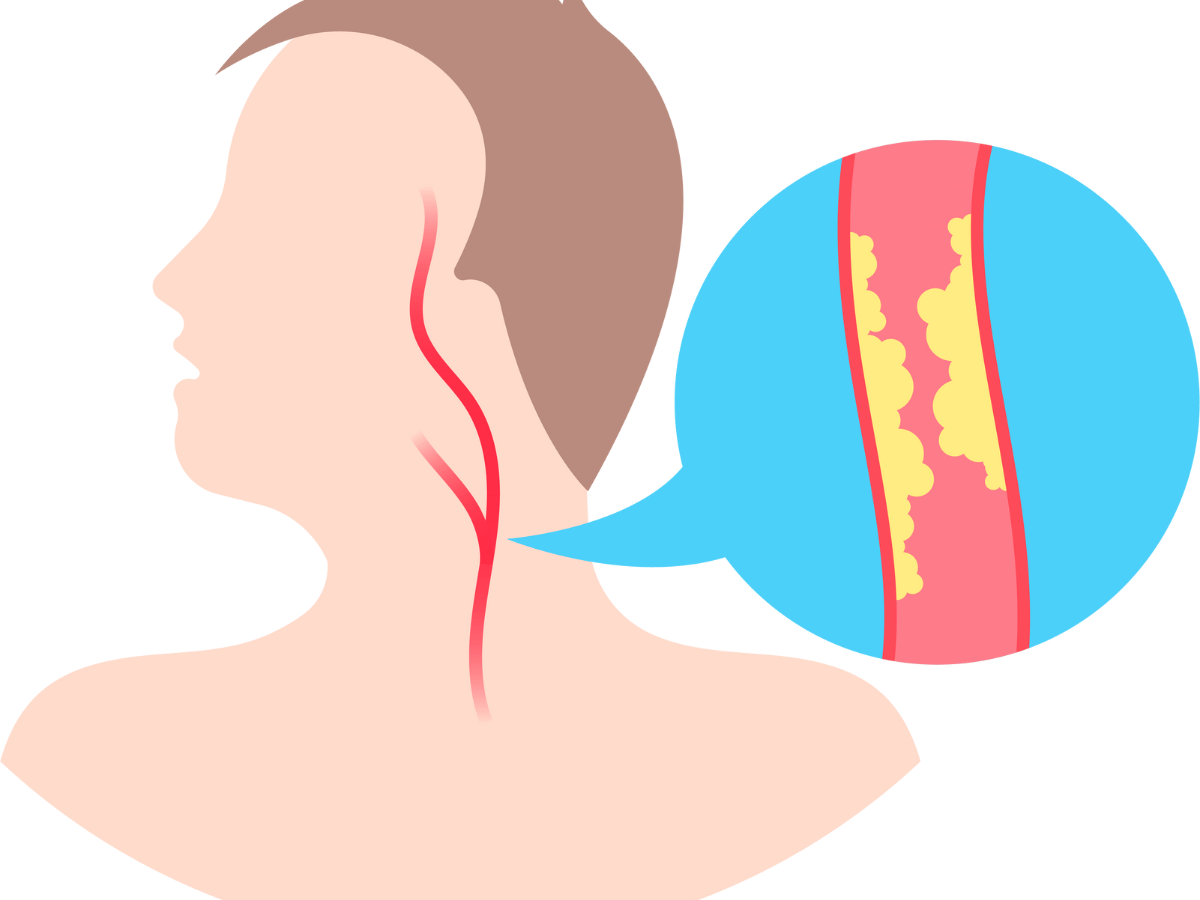 an image showing carotid artery with fat deposits