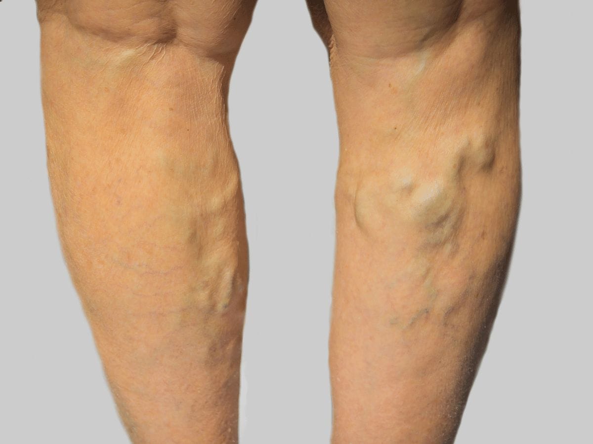 A patient showcasing their varicose veins
