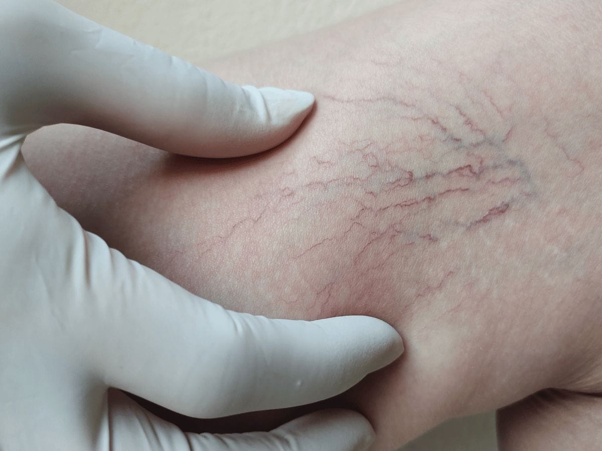 A doctor zooming in on the spider and reticular veins of a patient