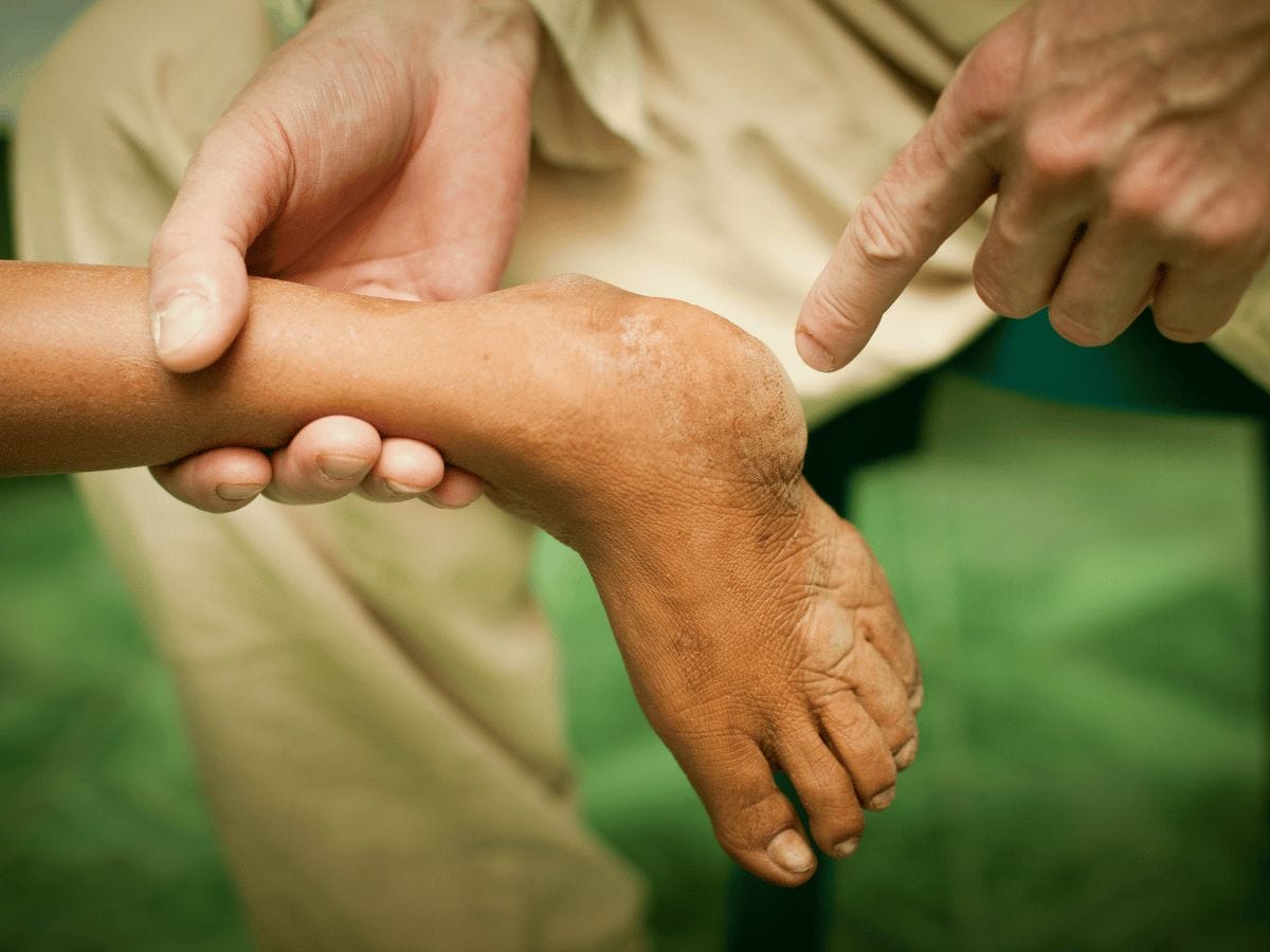 foot of a patient effected rearfoot disorder