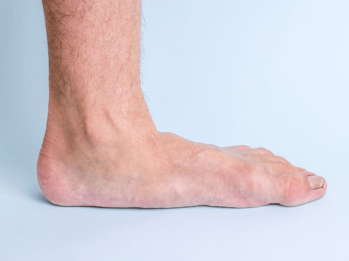 A patient's flat feet