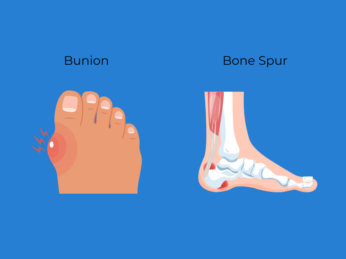 an image showcasing bunion and bone spur effected area in the human body