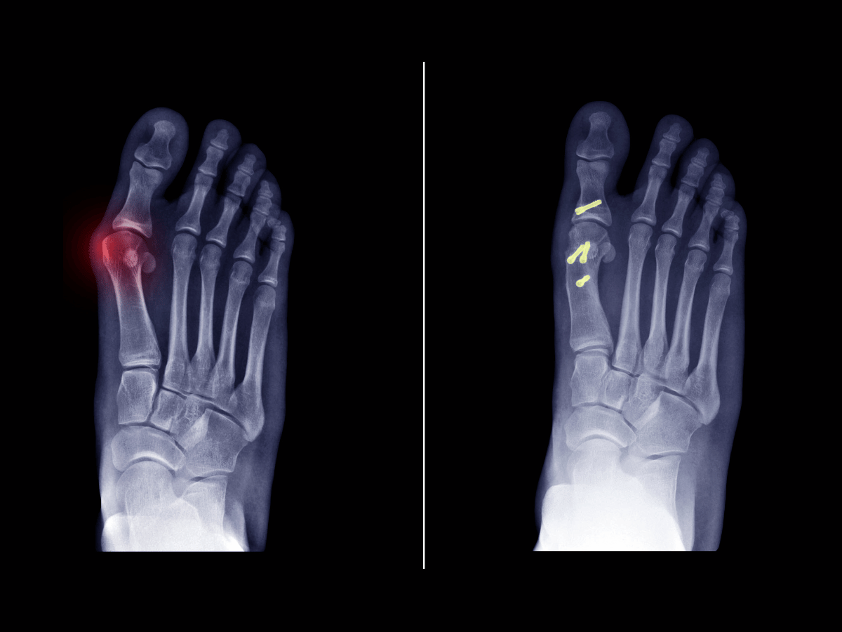 An x-ray image showing before and after of MIS bunion surgery