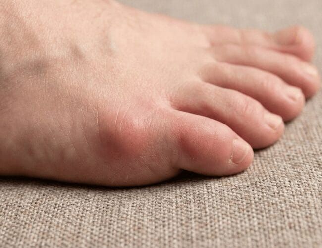 Tailor’s Bunion: Causes, Symptoms & Treatment in Miami