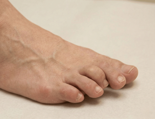 Claw Toes: Why They Happen & How We Treat Them in Miami