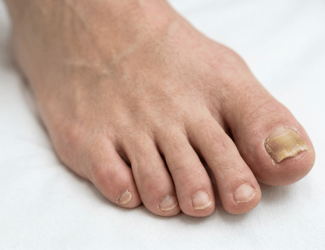 Image of a thick toenail