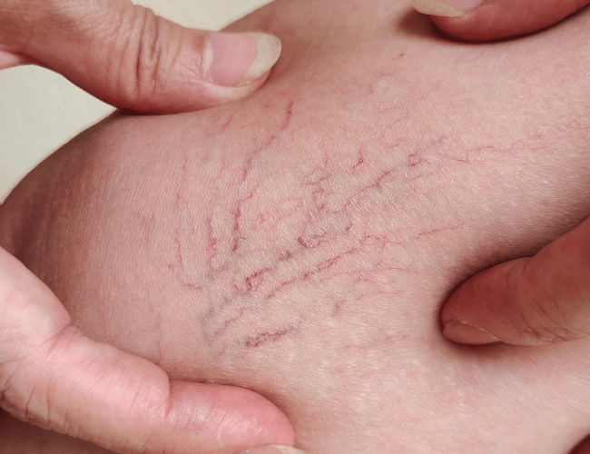 What causes varicose veins and how are they treated?